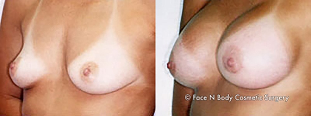 Breast Augmentation Before & After