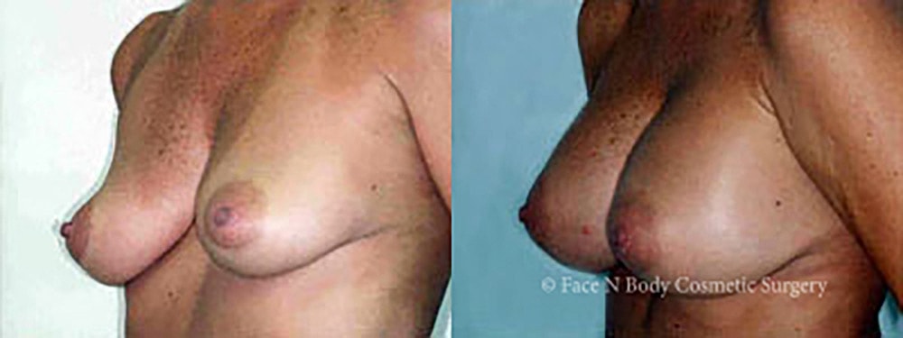 Breast Augmentation Before & After