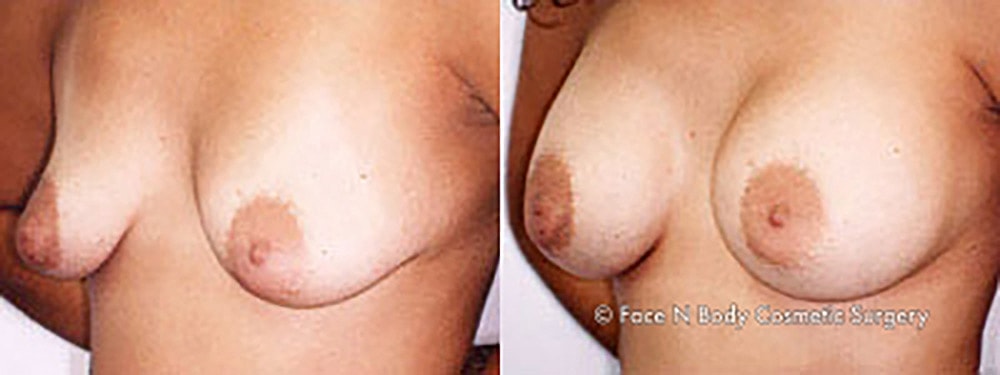 Breast Augmentation Before & After