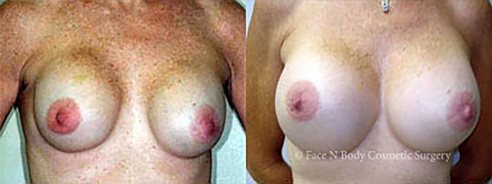 Breast Augmentation Before & After