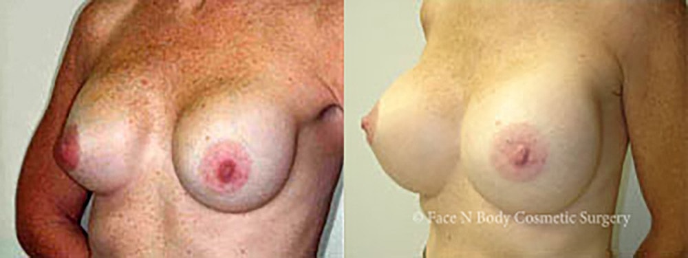 Breast Augmentation Before & After