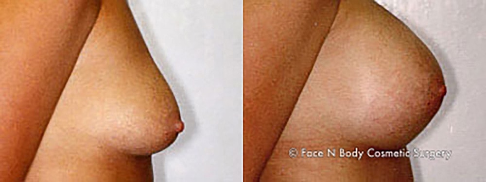 Breast Augmentation Before & After