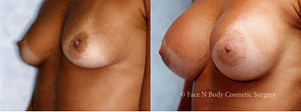 Breast Augmentation Before & After