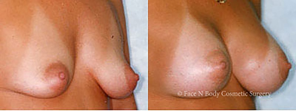 Breast Augmentation Before & After