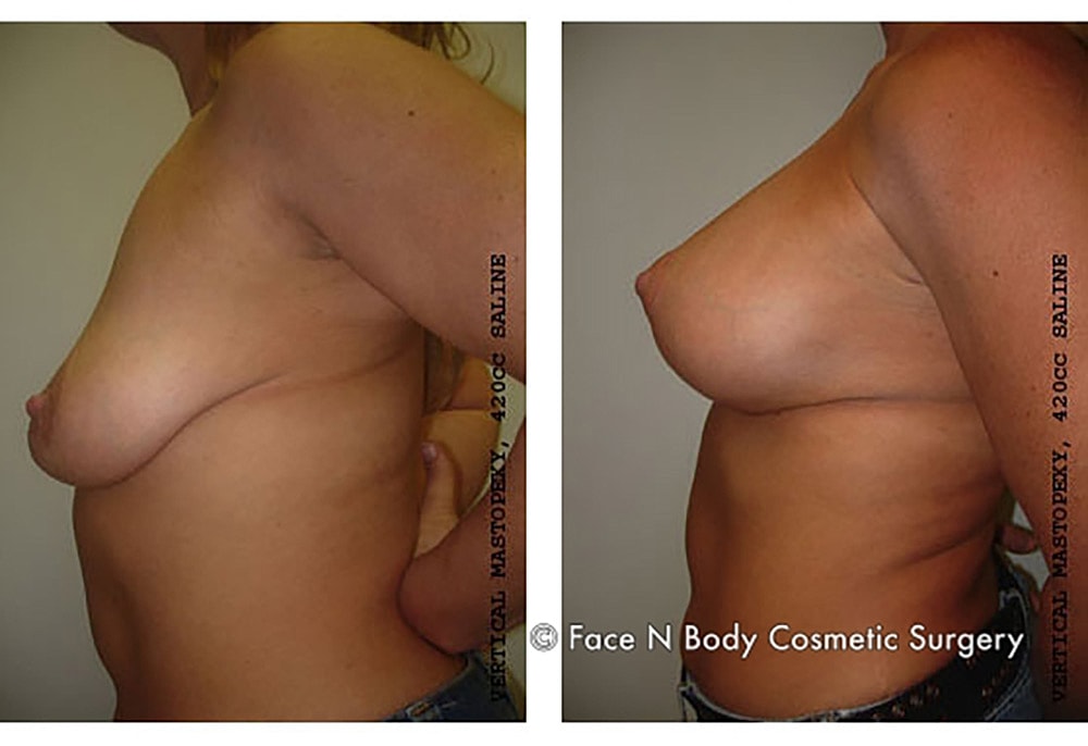 Breast Lift Before & After