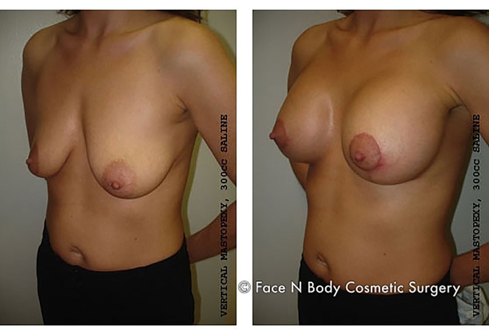 Breast Lift Before & After