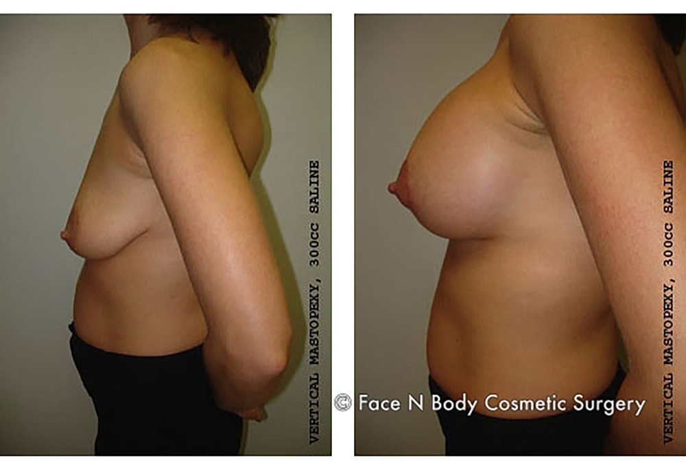 Breast Lift Before & After