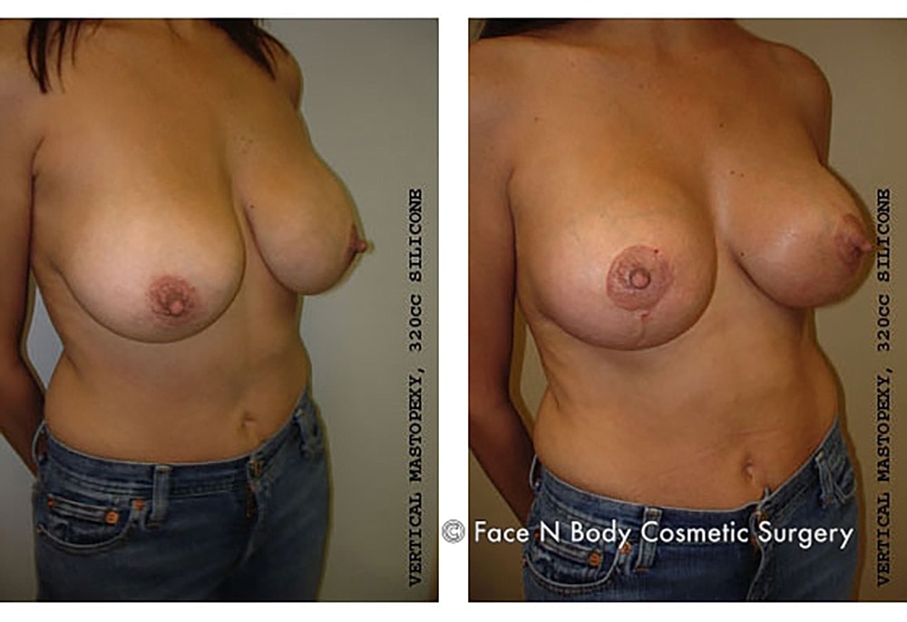 Breast Lift Before & After