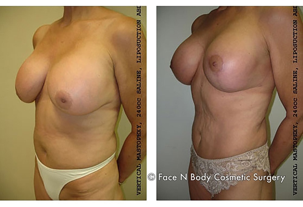 Breast Lift Before & After