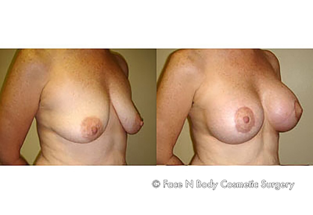 Breast Lift Before & After