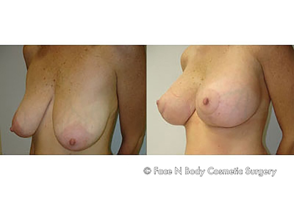Breast Lift Before & After