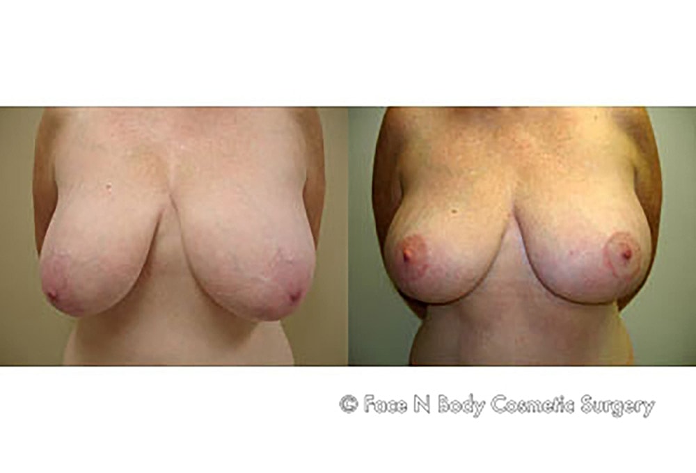 Breast Lift Before & After