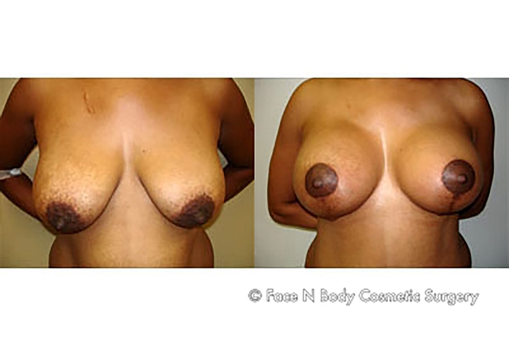 Breast Lift Before & After