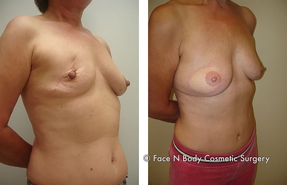 Breast Cancer Reconstruction Before & After