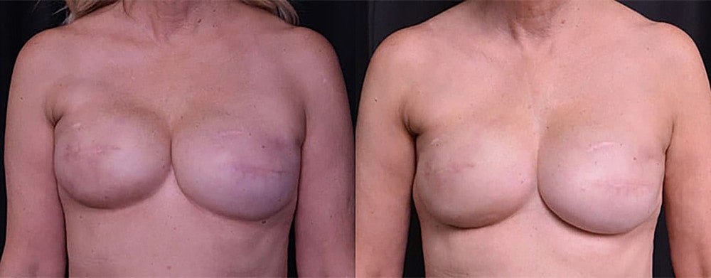 Breast Cancer Reconstruction Before & After