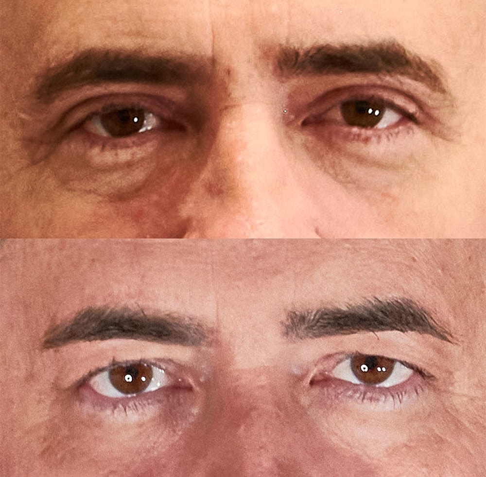 Eyelid Lift Procedure Before & After