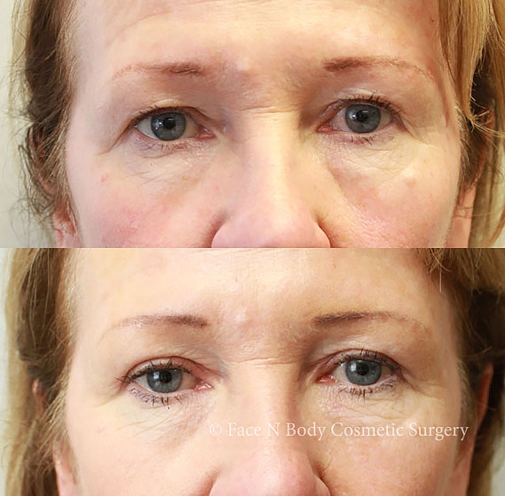 Eyelid Lift Procedure Before & After
