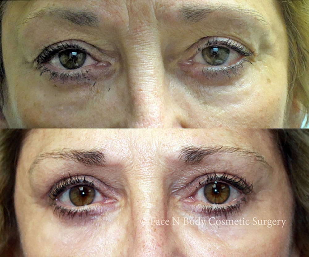 Eyelid Lift Procedure Before & After