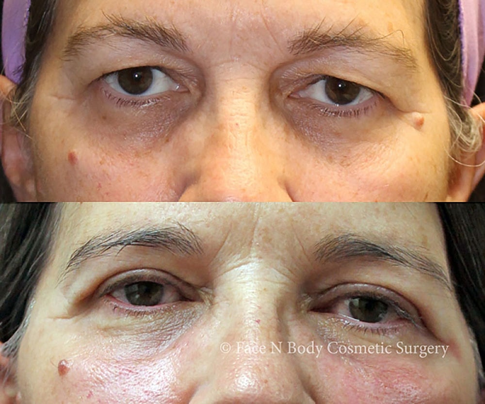Eyelid Lift Procedure Before & After