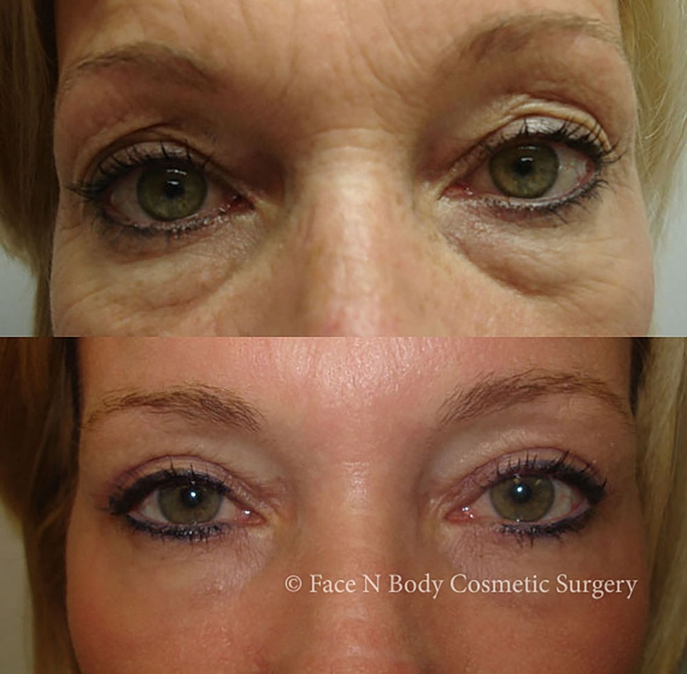 Eyelid Lift Procedure Before & After