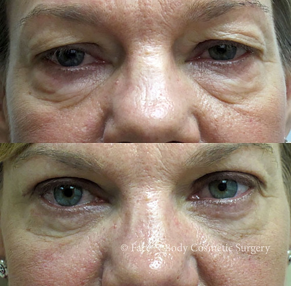 Eyelid Lift Procedure Before & After
