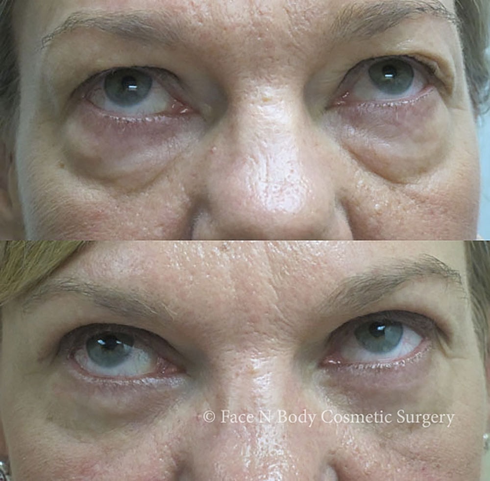 Eyelid Lift Procedure Before & After