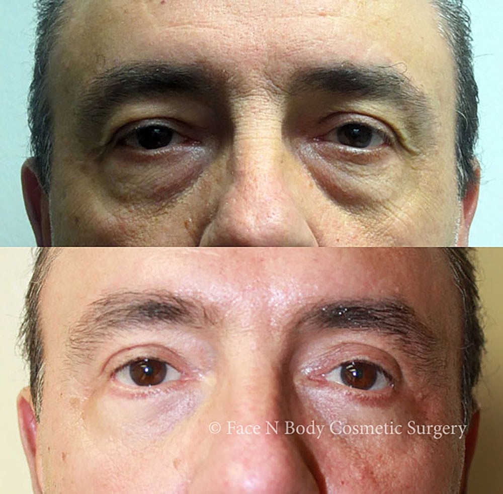 Eyelid Lift Procedure Before & After