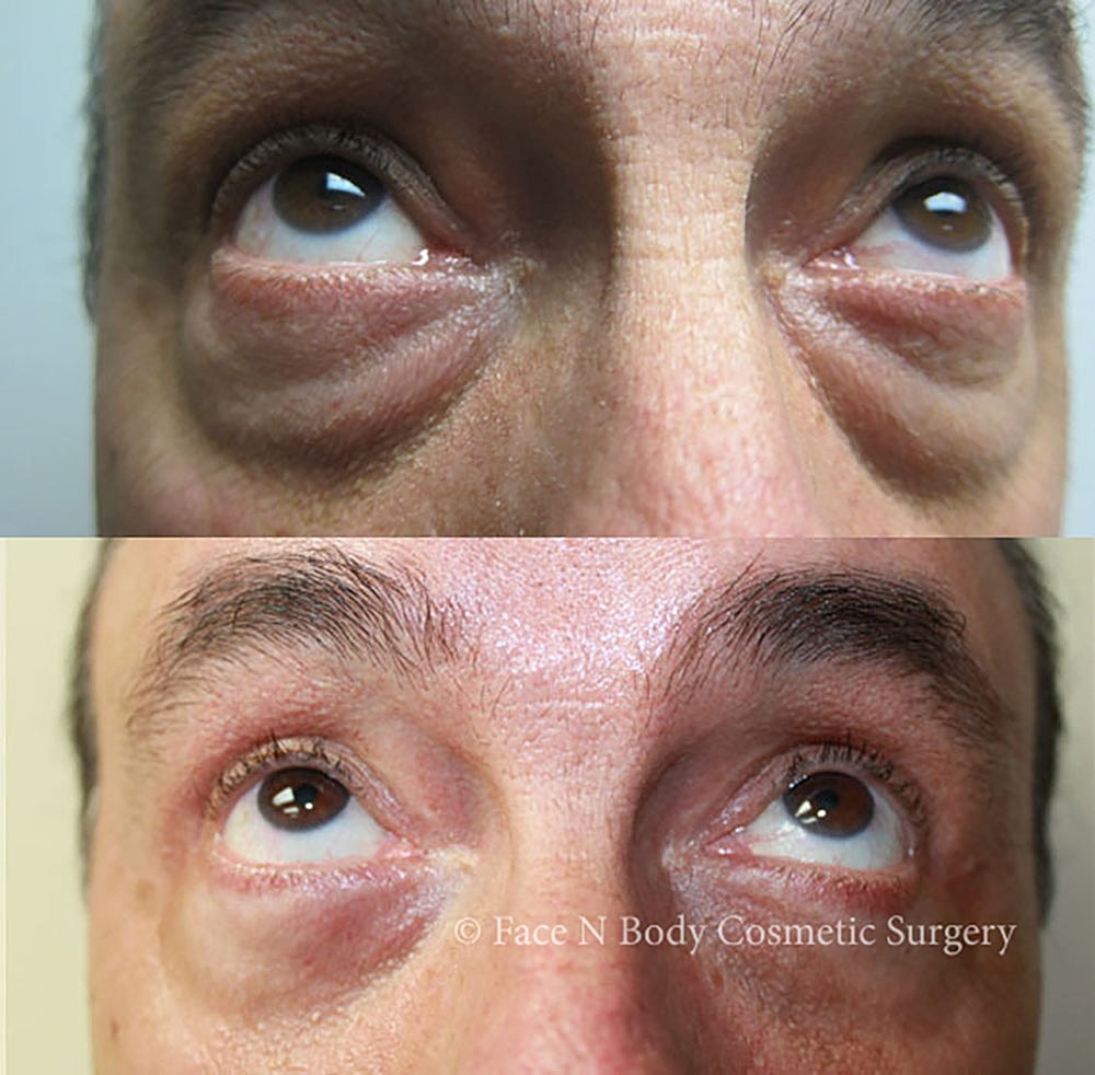 Eyelid Lift Procedure Before & After