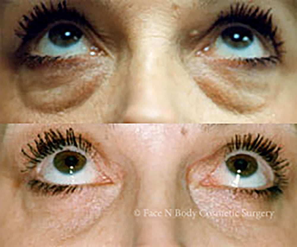 Eyelid Lift Procedure Before & After