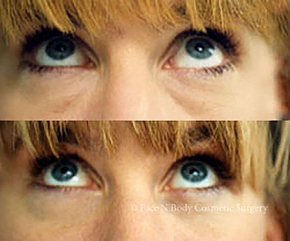 Eyelid Lift Procedure Before & After