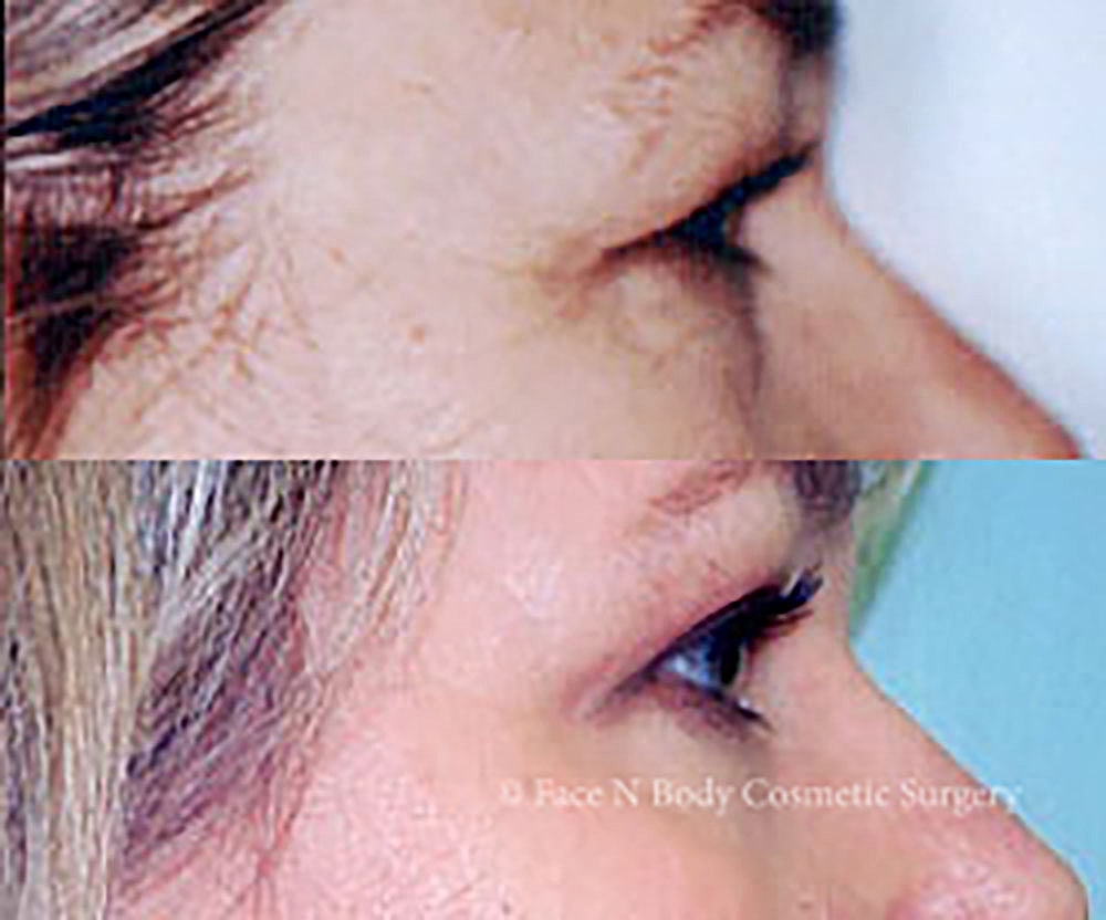 Eyelid Lift Procedure Before & After