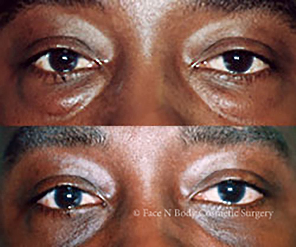 Eyelid Lift Procedure Before & After