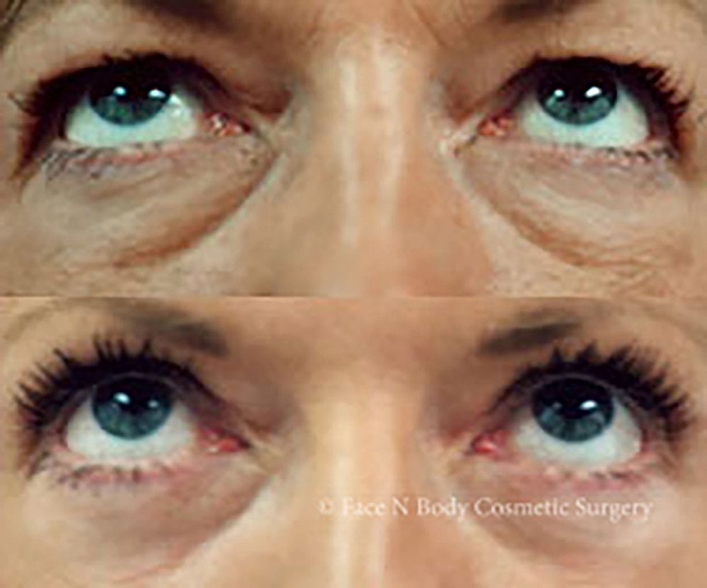 Eyelid Lift Procedure Before & After