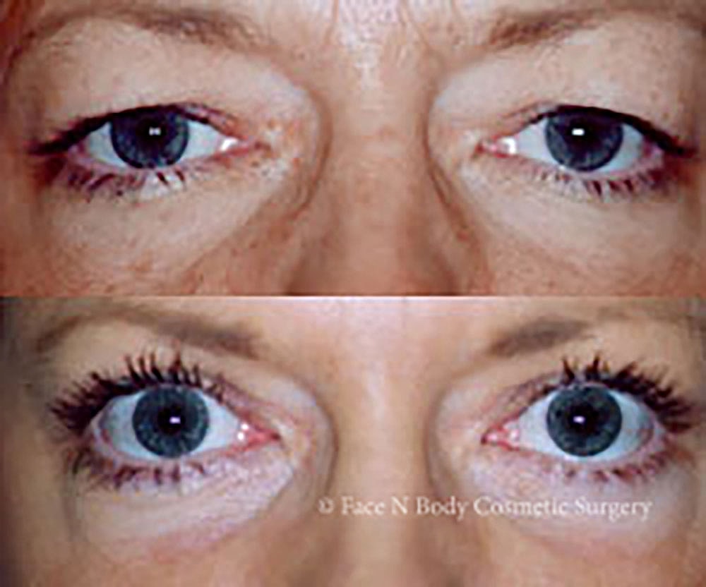 Eyelid Lift Procedure Before & After