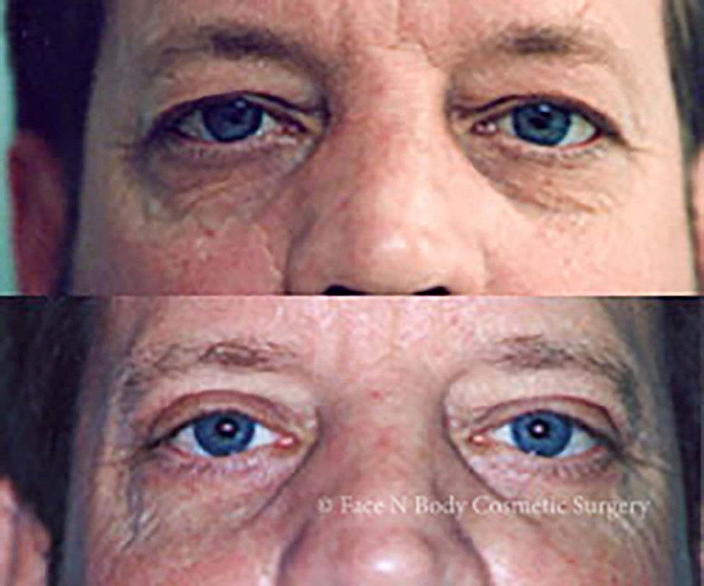Eyelid Lift Procedure Before & After