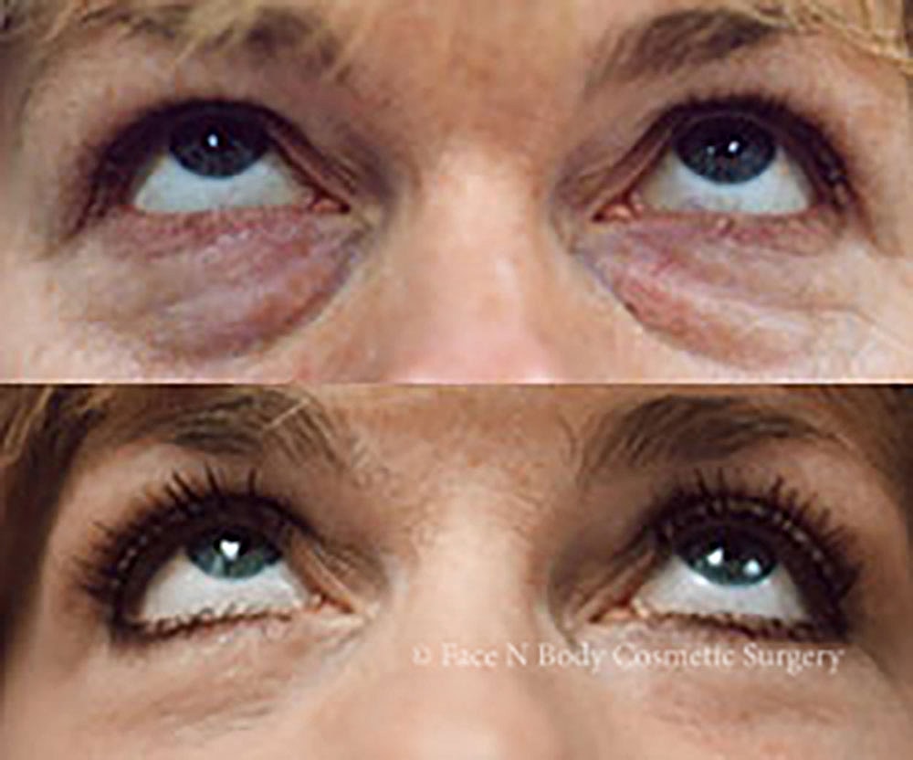 Eyelid Lift Procedure Before & After
