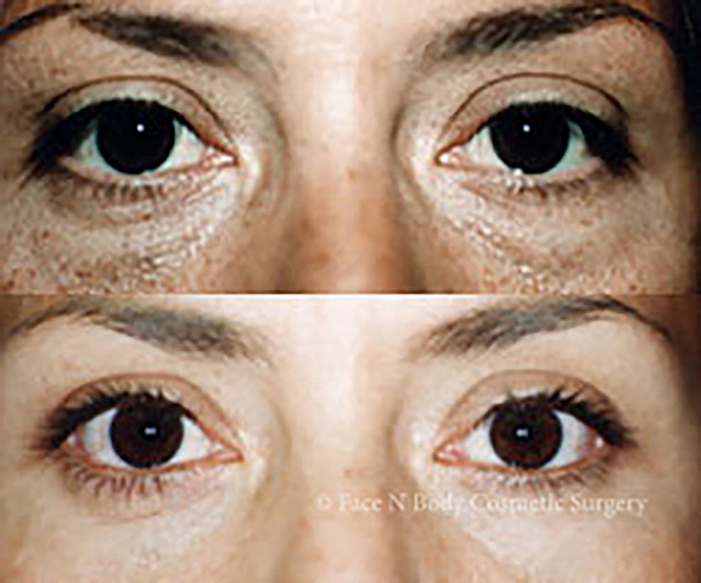 Eyelid Lift Procedure Before & After