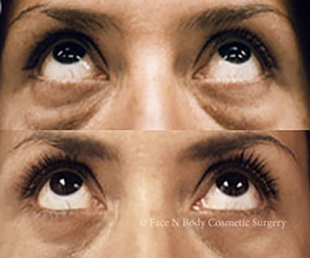 Eyelid Lift Procedure Before & After