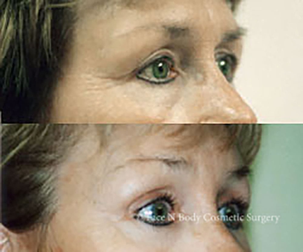 Eyelid Lift Procedure Before & After
