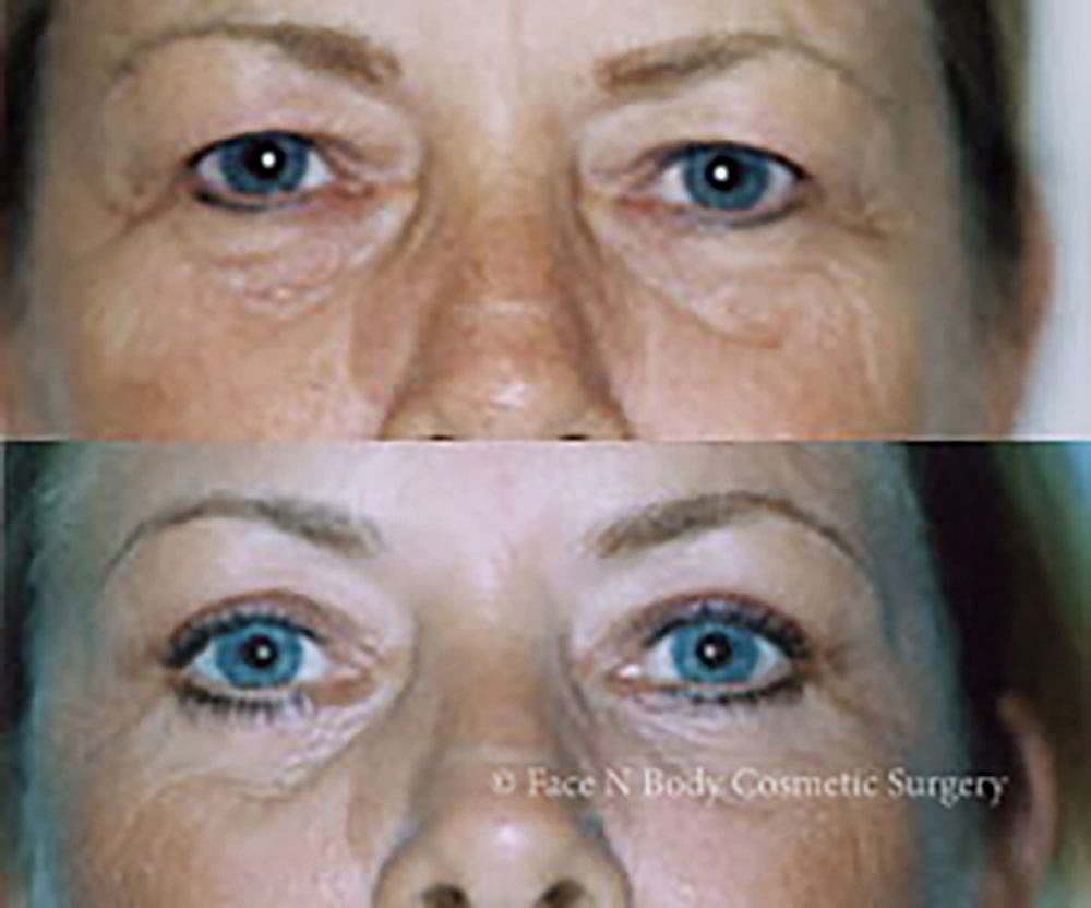 Eyelid Lift Procedure Before & After