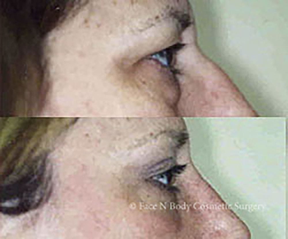 Eyelid Lift Procedure Before & After
