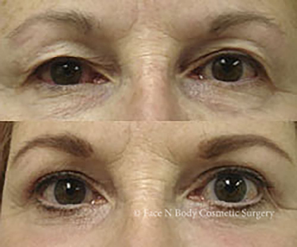 Eyelid Lift Procedure Before & After