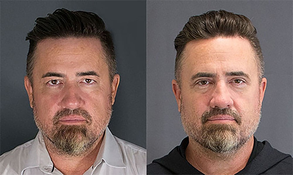 Eyelid Lift Procedure Before & After