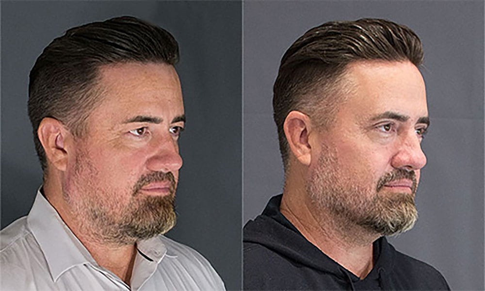 Eyelid Lift Procedure Before & After