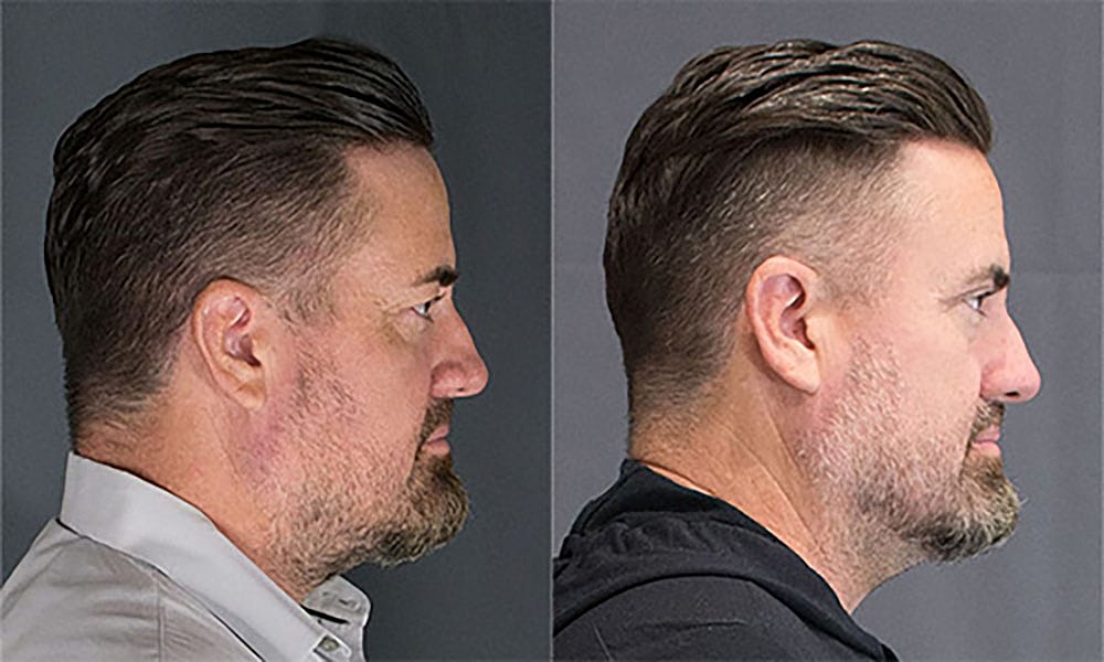 Eyelid Lift Procedure Before & After