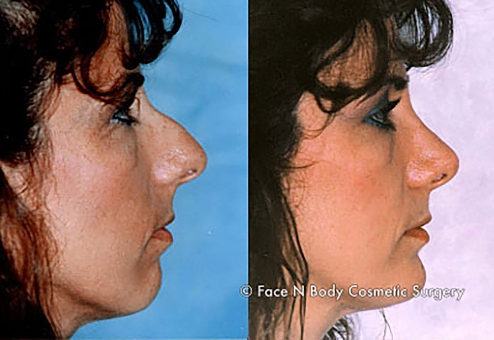 Chin Augmentation Before & After