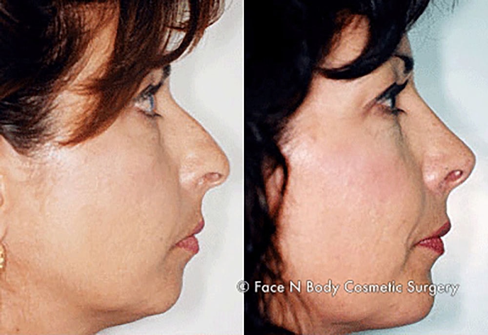 Chin Augmentation Before & After