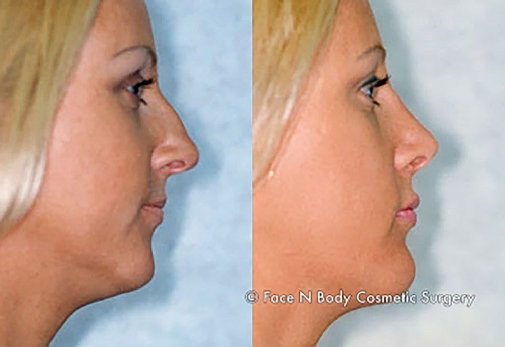 Chin Augmentation Before & After