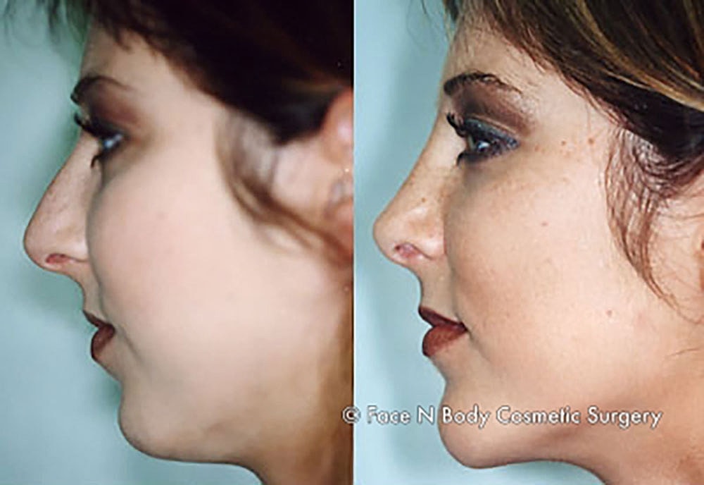 Chin Augmentation Before & After