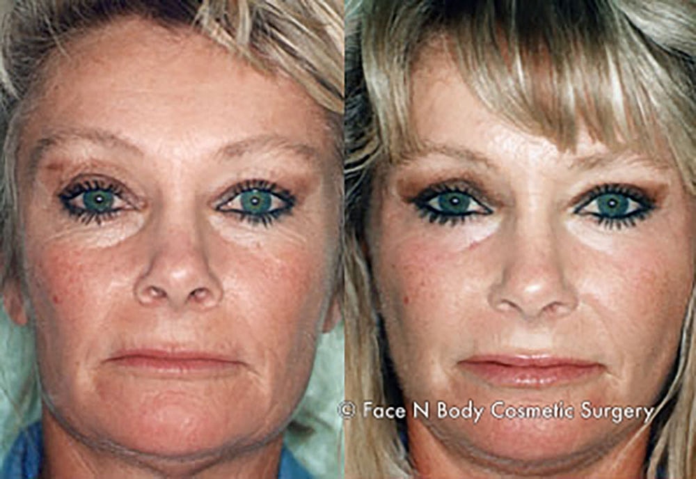 Chemical Peels Before & After